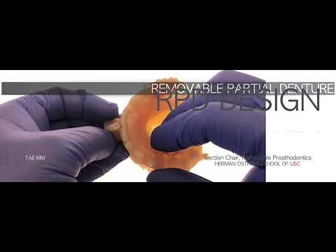 RPD metal frame design