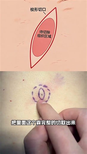 皮脂腺囊肿为什么不能用手挤呢？#囊肿 #皮脂腺囊肿 #硬核健康科普行动 #医疗健康创作训练营