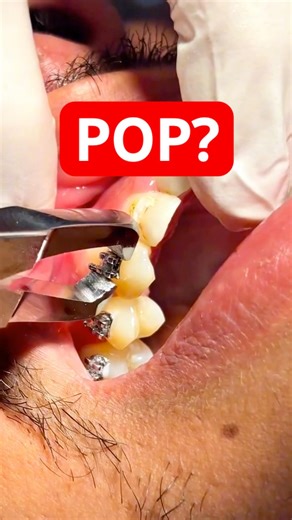 The Most Satisfying Bracket Removal You’ll Hear Today 🔊