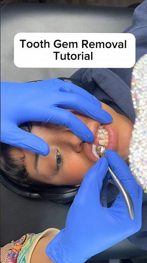 Tooth Gem Removal Tutorial ✨