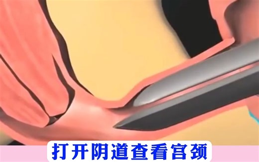 阴道镜检查全过程，到底有多疼