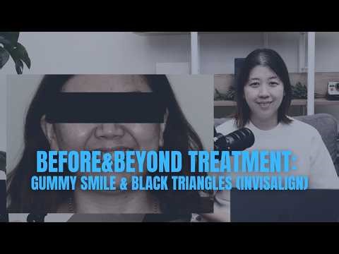 Black Triangles & Gummy Smiles: Can Invisalign Really Fix Them?! | BEFORE & BEYOND EP60