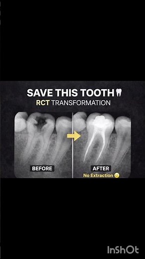 **“Severe tooth pain ➡️ Pain-free in one visit 😳🦷Hidden infection removed… tooth saved, not removed