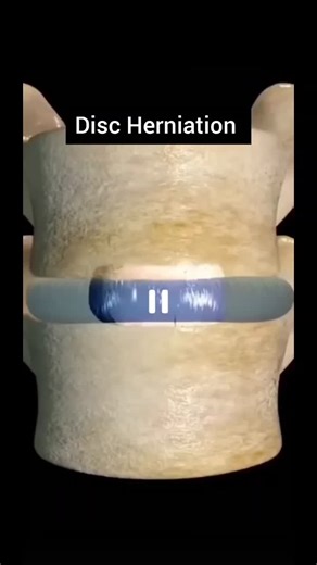 Disc herniation (commonly called a slipped disc) occurs when the nucleus pulposus — the soft, gel-like center of the spinal disc — bulges or leaks out through a tear in the tough outer layer (annulus… | Nisharani Pati