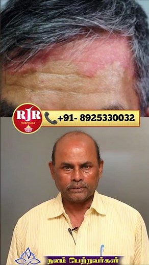 Psoriasis on the face 😳 This is how it's done 😲 | Psoriasis problems