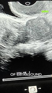 1.3M views · 6.4K reactions | It Started With Severe Cramps #SeenSexEd #IAmSeen #ReproductiveHealth #UterusDidelphys #Uterus #WomensHealth #Pregnancy #Pregnant #Mom #Kids #Cramps #Women #FYP #ForYouPage | seen.tv | Facebook