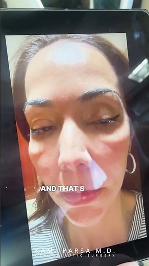 Dissolving Tear Trough Fillers