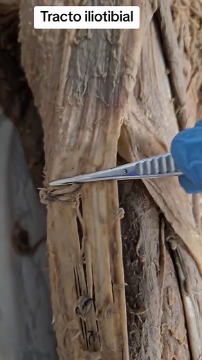 Músculo Tensor de la Fascia Lata y Tracto Iliotibial