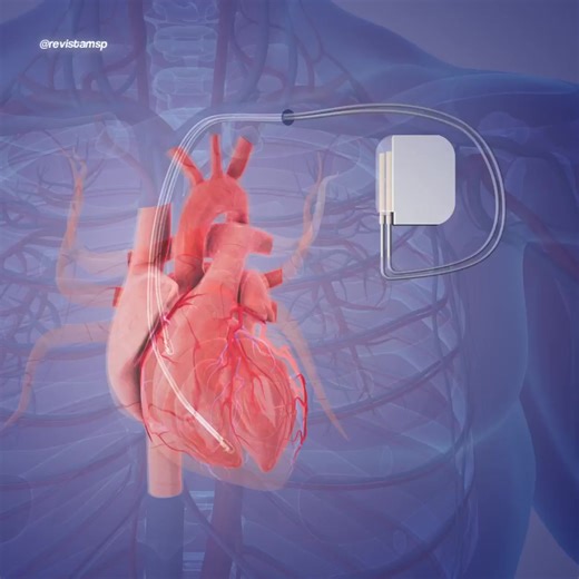 #MSPCardiología | Un marcapasos es un dispositivo médico que sustituye o corrige el ritmo natural del corazón cuando el nodo sinoauricular falla. Emite impulsos eléctricos controlados que estimulan el miocardio y mantienen un latido regular. #MSP: El lugar donde médicos, pacientes y profesionales de la salud pueden entrar. #SomosCiencia #MSPLíderesPioneros #MSPLegadoQueInspira | Revista Medicina y Salud Pública