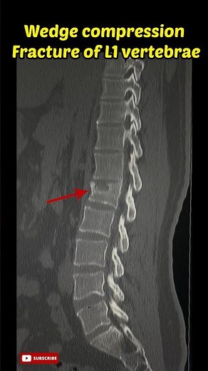 Wedge compression fracture lumbar vertebrae #lumbarspine #fracture #xray #radiology #shorts