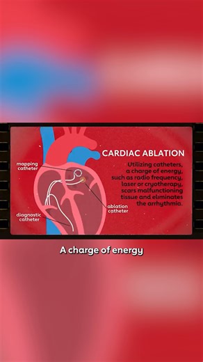 Atrial fibrillation causes a rapid or irregular heartbeat that could have serious consequences. A minimally invasive procedure called ablation can help restore a normal heart rhythm. If you're living with AFib, talk to a doctor about what's right for you. HCA Healthcare Foundation is the national sponsor of Getting to the Heart of Stroke™. | American Heart Association - Arkansas | Facebook