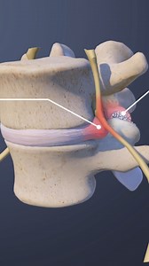 Need to understand spinal conditions affecting the L4-L5 spinal motion segment? This video covers common issues like herniated discs, lumbar spinal stenosis, degenerative disc disease, and spondylolisthesis. Learn about symptoms, diagnosis, treatment options, and how these conditions impact lower back pain and mobility. Perfect for students, healthcare professionals, or anyone searching for information on lumbar spine disorders, lower back pain relief, and spine health. | Spine-health