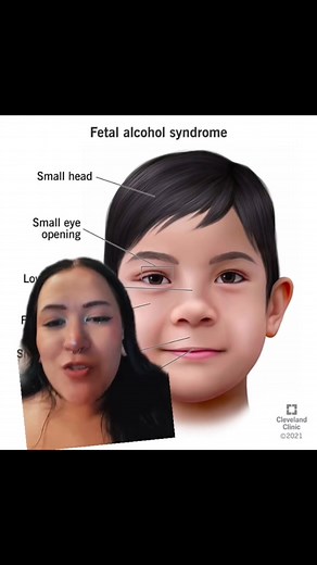 Understanding Fetal Alcohol Syndrome: Key Features Explained