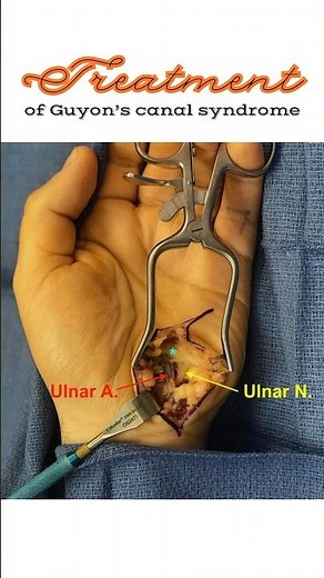 Treatment of Guyon’s canal syndrome, Ulnar tunnel syndrome #shorts