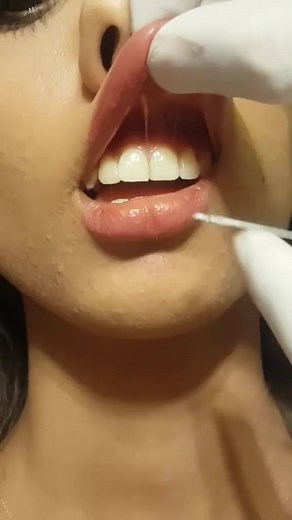 Smiley Piercing Procedure #smileypiercing #smileypiercings piercing.world | piercing.world