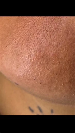 threads on Instagram: "Full video on my youtube #hairy #threading #pcos #threadinghairremoval #satisfying #beautycare #beauty #beforeandafter #grooming #chin #relaxingasmr #beautytreatment"