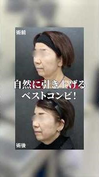 Lift-up with hyaluronic acid and thread lift! I saw a huge change ✨ [Osaka Umeda Private Skin Cli...