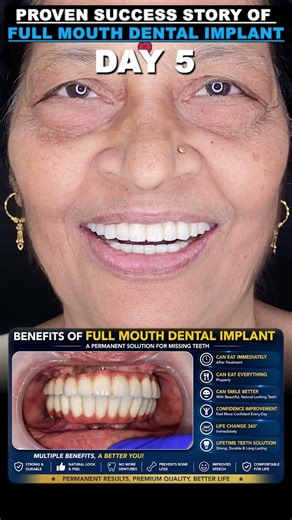 Full Mouth Dental Implants | Truly Life-Changing Results - Dr Mayur Khairnar