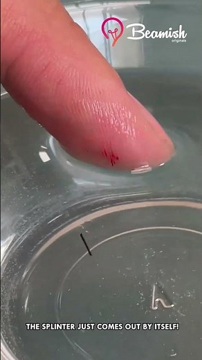 Easy Splinter Removal Trick #easy #removal #tricks