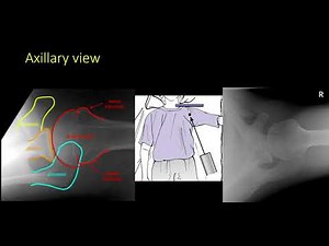 Proximal humerus fracture