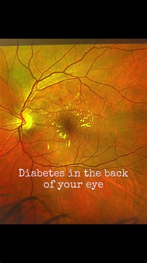 What diabetes can look like in the back of your eye…explained by an Optometrist #eye #vision #healthcare #diabetes #fyp