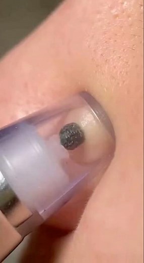 Deep Pore Cleansing: Professional Blackhead & Sebaceous Filament Removal
