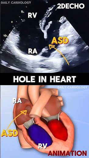 Atrial Septal Defect (ASD) Hole in Heart (2DEcho vs Animation) #shorts #asd #echocardiography