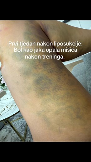 Understanding Lipodema Symptoms and Treatments