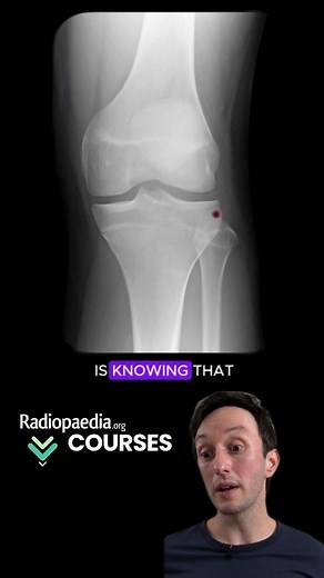 🚀 Level up your xray reporting skills! Check out our video courses for more awesome teaching such as this by Andrew Murphy. 💻 Sign up at radiopaedia.org/courses and don't forget that if you live in one of the 125 low and middle income countries listed on our website, you can access the entire teaching library for free! | Radiopaedia.org