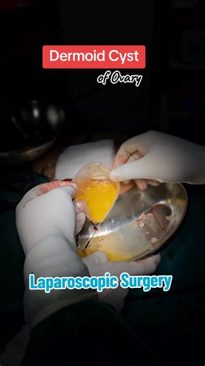 Laparoscopic Surgery for Dermoid Cyst Treatment