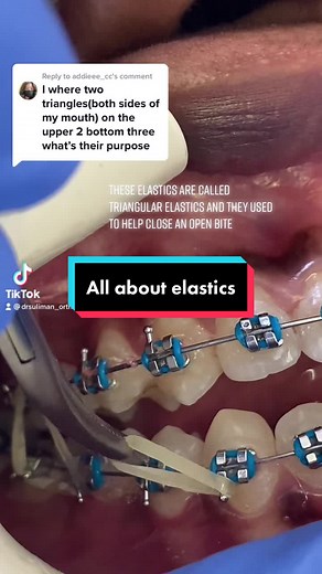 Triangle Elastics in Braces: How to Use Them Correctly