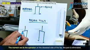 27 reactions · 4 comments | Dr. Ashwani Maichand is a renowned Hip...