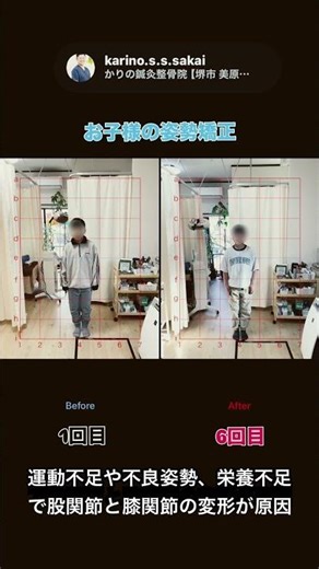 【堺市 美原区】内股と膝の屈曲制限の学生様に姿勢改善とトレーニング指導【かりの鍼灸整骨院】