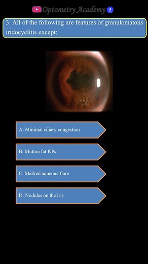 8.1K views · 52 reactions | Granulomatous Iridocyclitis | Optometry Academy | Facebook