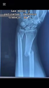 Fractura de radio y cúbito. 🔨🦴 @dr.edwingallego | Edwin Gallego Gonzalez