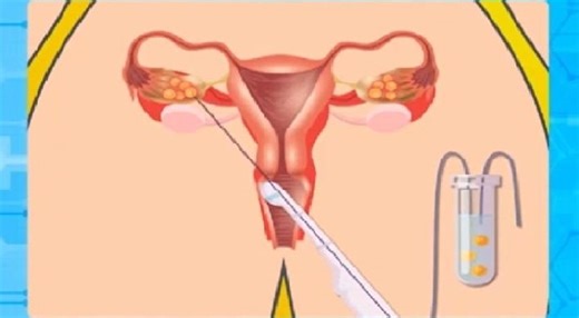 ALAMIN: In-vitro fertilization, paano nga ba isinasagawa?