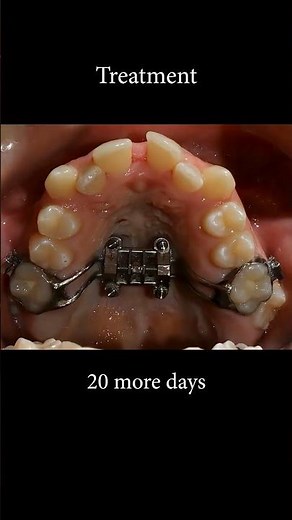 Expansion of Narrow Palate with 4 Miniscrews! Part I #orthodontist