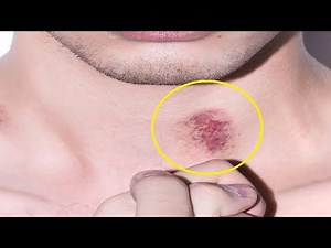 how to give a love bite mark to your girlfriend