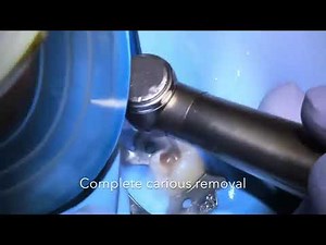 pulpotomy for primary tooth step by step