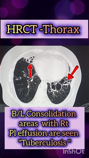 CT THORAX "Tuberculosis" #Shorts #trending #viral#ytshorts#shortsfeed