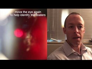 Laser Floater Removal (vitreolysis) patient procedure and testimonial by Dr. Paul Singh