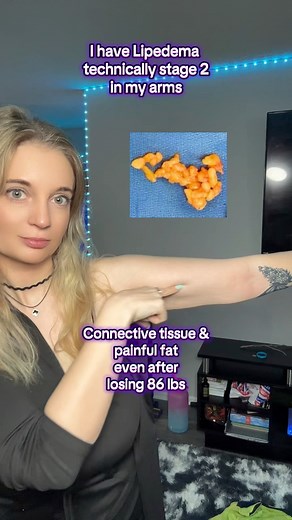 10K views · 27 reactions | Managing Lipedema in the arms starts with...