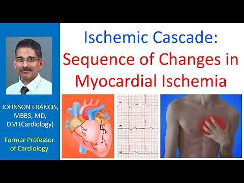Ischemic cascade: Sequence of changes in myocardial ischemia