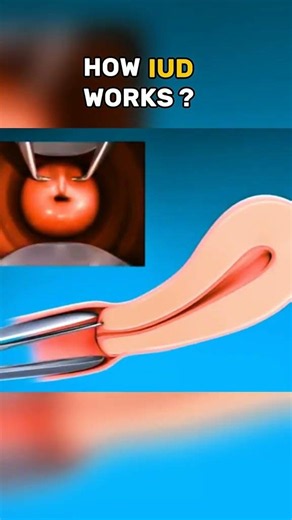 Polycystic Kidney Disease Explained | 3D Animation #KidneyHealth #MedicalEducation