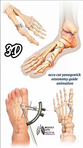 accu cut youngswick osteotomy guide animation #medical #animation #3d #short | BiologywithAliya