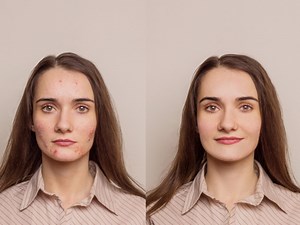 16 Effective Ways to Remove Acne Scars | Organic Facts