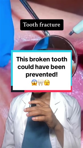 Preventing Broken Teeth with Dental Crowns
