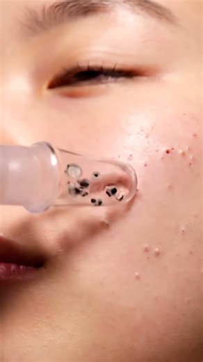 Giant Blackhead POP — So Satisfying to Watch