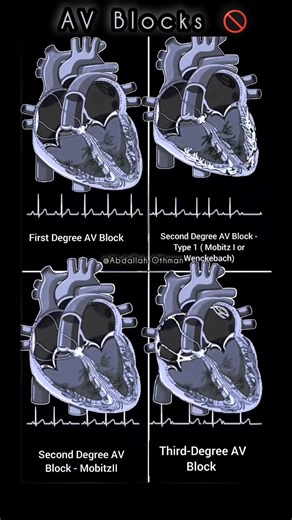 13K views · 100 reactions | #AV_Block | Médecine générale | Facebook