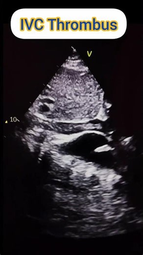 IVC thrombus echo video